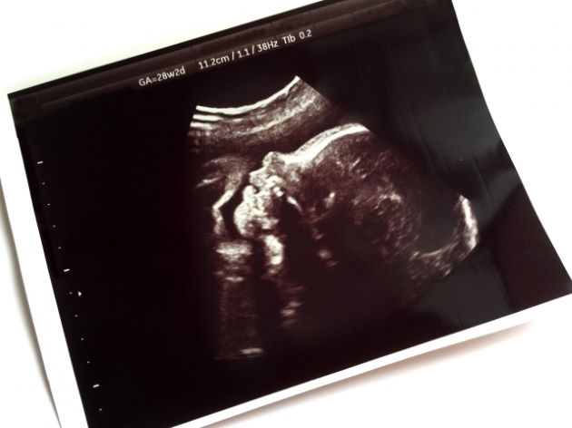 赤ちゃんの横顔のエコー写真